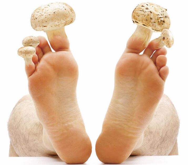 Foot and nail fungus