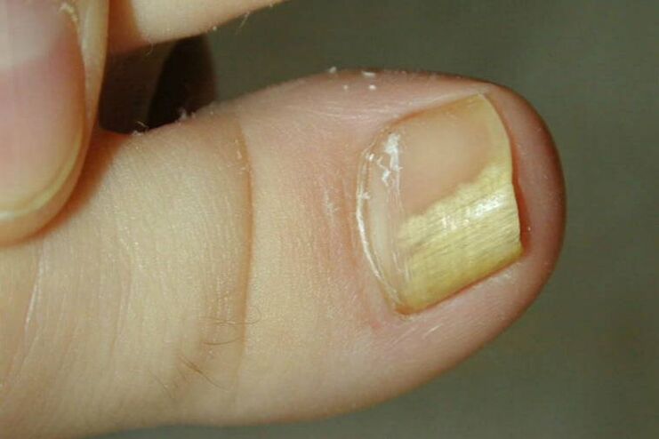 Symptoms of fungus on the big toe photo 1