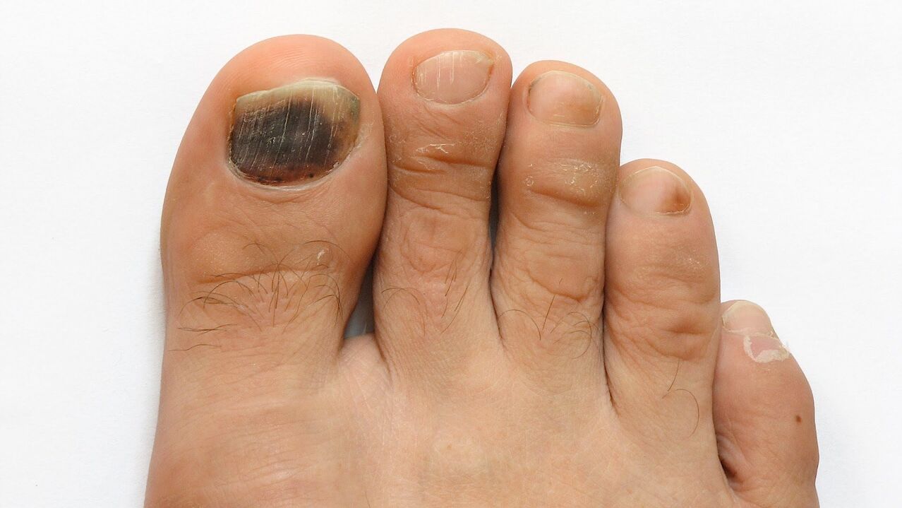 Symptoms of fungus on the big toe photo 2
