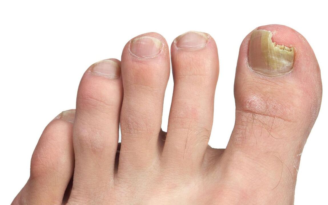 Symptoms of fungus on the big toe photo 3