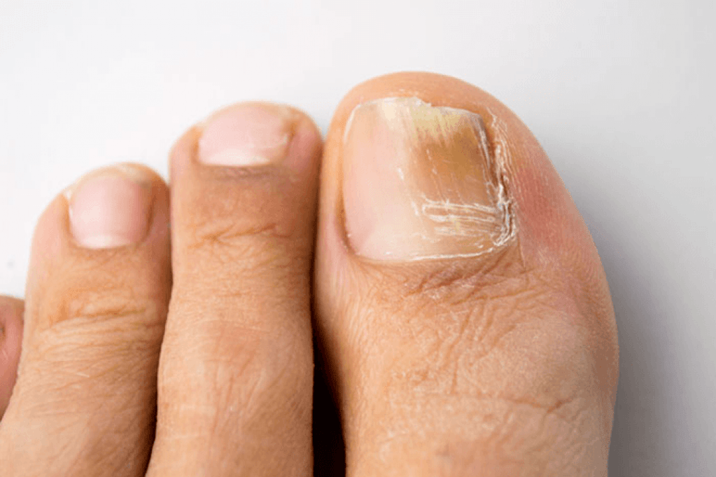 Symptoms of fungus on the big toe photo 4