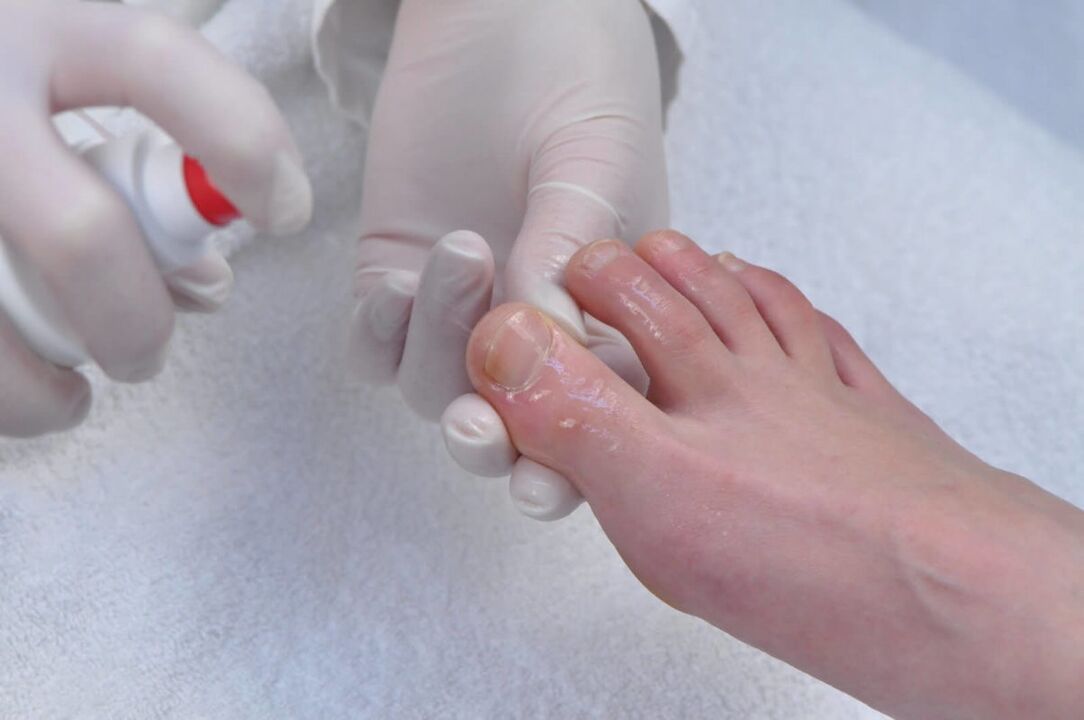 nail fungus spray