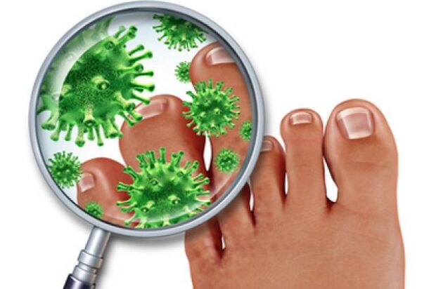 fungal infection on toenails