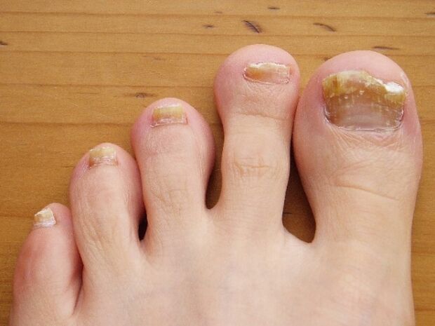 spoil the nail plate with fungus
