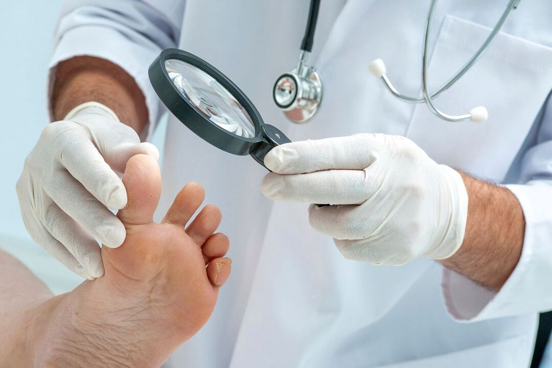 The doctor examines the foot for fungal infection