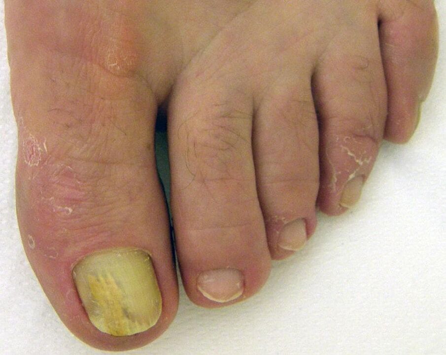 Yellow nail fungus how to treat with drops