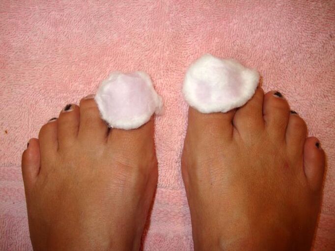 lotion for fungus on feet