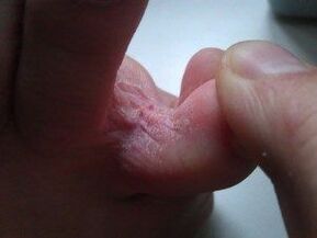 skin lesions between the toes with fungus