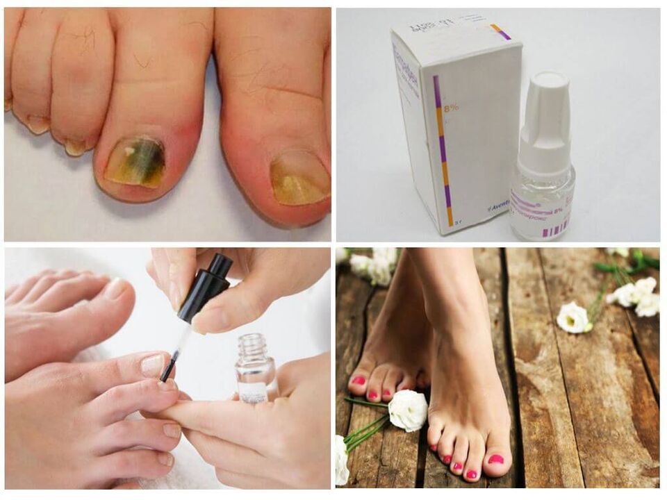 How to use antifungal nail polish