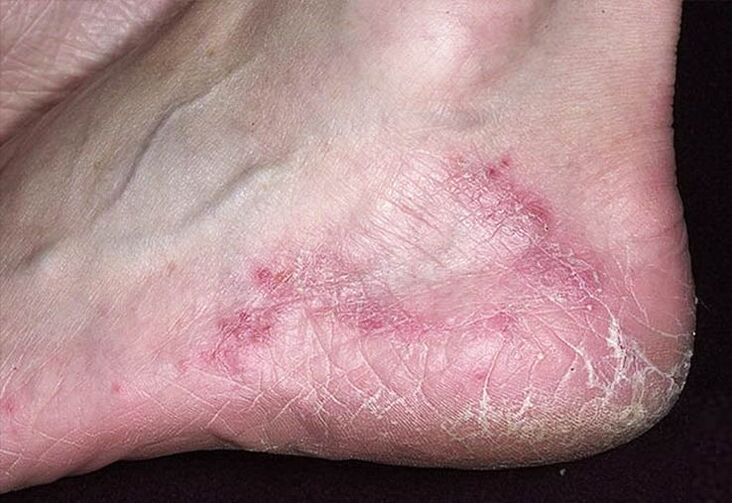 Cracks and redness in the heel skin are signs of a fungal infection