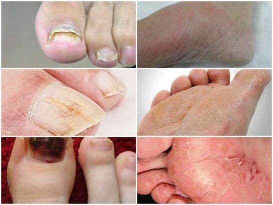 What does foot fungus look like 