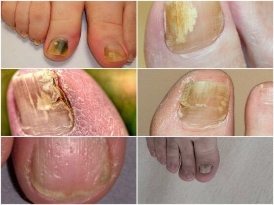symptoms of nail fungus infection