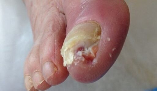 A nail is ill