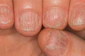 Mushroom lesions