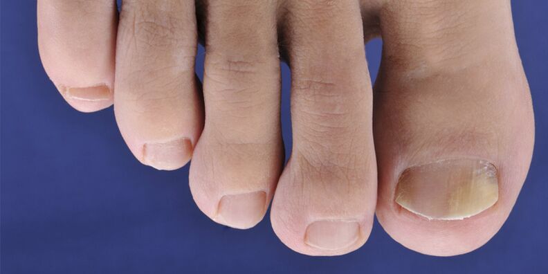 Symptoms of Mycosis and nails