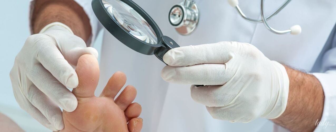 The doctor checks the fungus on the toe