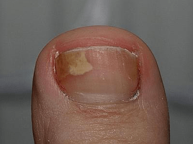 mushrooms on the left side of the nail