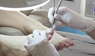 Nail cutting surgery with the presence of a mushroom