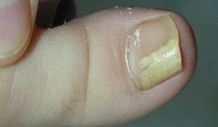Signs and symptoms of nail mushrooms