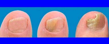 The growth stages of mushrooms on the toe