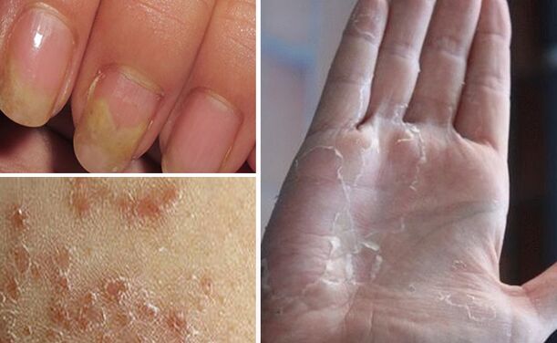 Mycosis can switch to other parts of the body