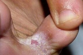 Fungal symptoms between toes
