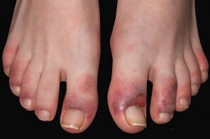 Fungal symptoms in toes