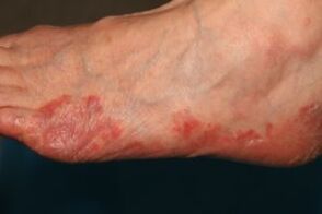 Symptoms of fungus on the feet