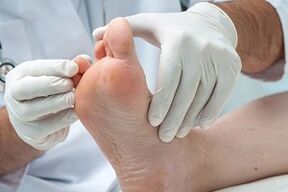 The doctor examined the feet to look for fungus on the toes