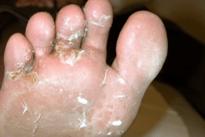 fungus on fingers and feet