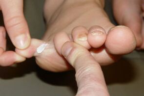fungus on toes
