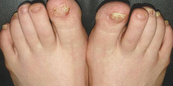 What is nail fungus