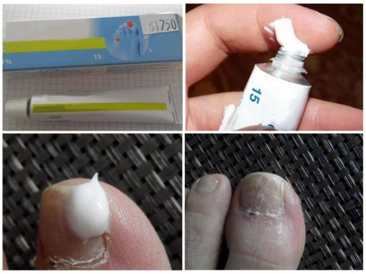 anti-fungal toenail ointment