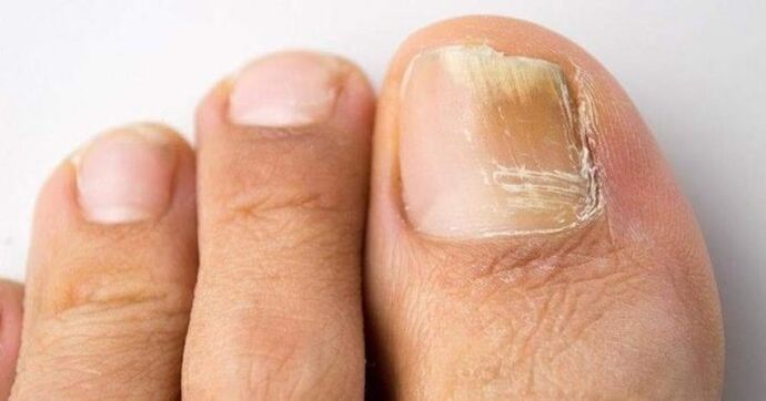 Yellow toenails infected with fungus