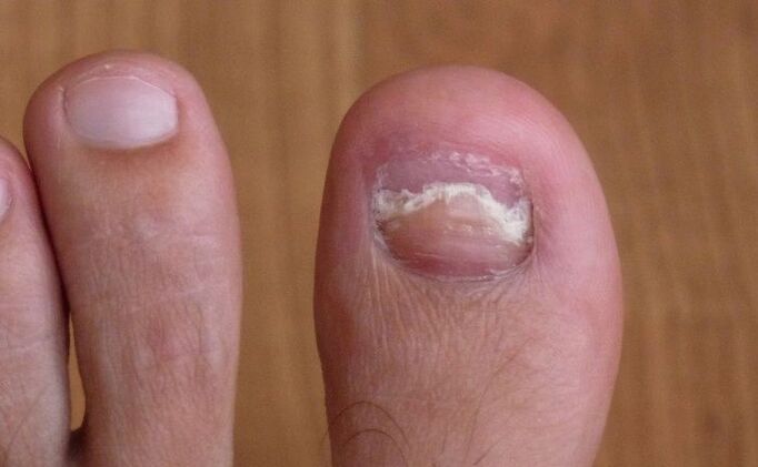 nail damage to the big toe due to fungus