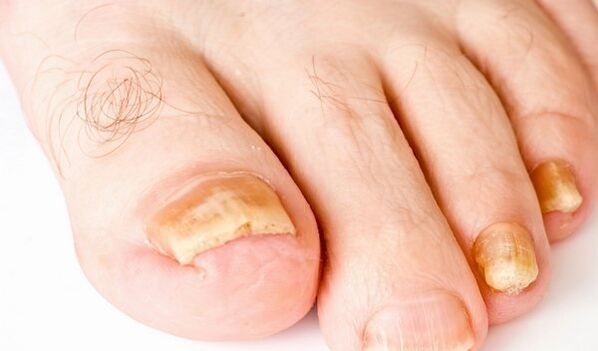 photo of the symptoms of toenail fungus