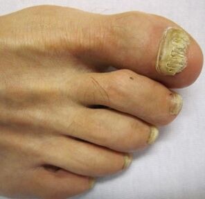 progression of toenail fungus