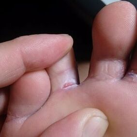 cracks between toes fungal symptoms